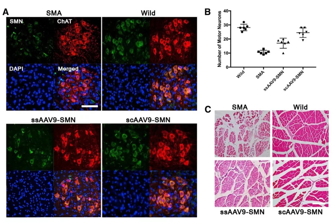 与时间赛跑，基于rAAV9载体胎儿基因治疗SMA新进展（一）
